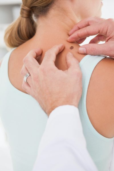 כתמים חומים על פני העור