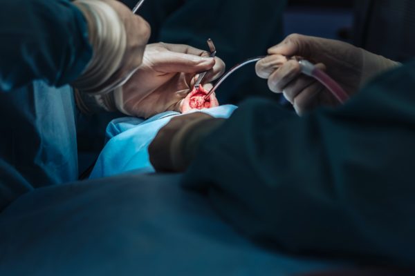 ניתוח אף החלמה