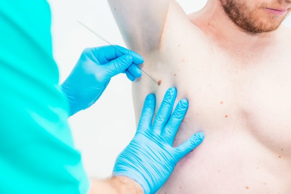 הסרת נקודות חן ללא צלקת