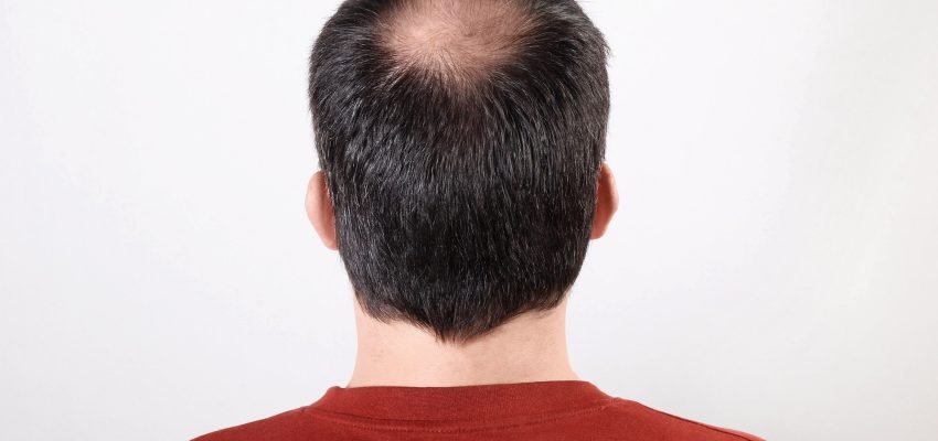 נשירת שיער פתאומית