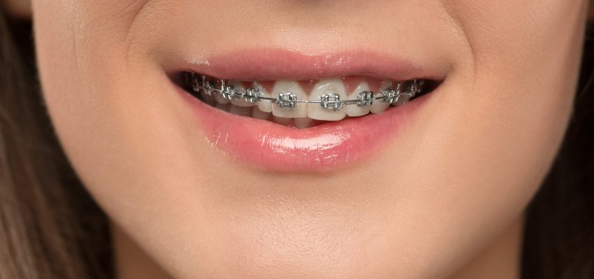 קוביות בשיניים