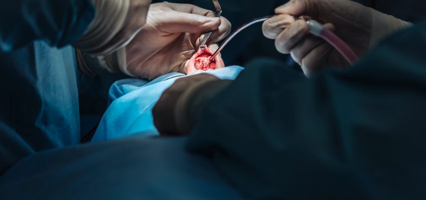 ניתוח אף החלמה