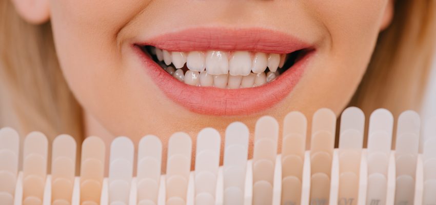 הלבנה לשיניים