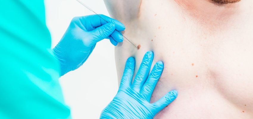 הסרת נקודות חן ללא צלקת