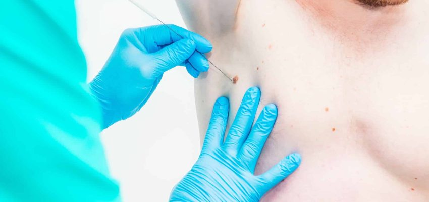 הסרת נקודות חן ללא צלקת