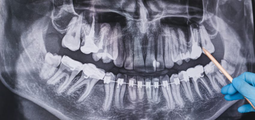 כאבים אחרי עקירה שן בינה