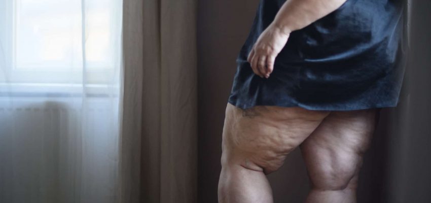 שאיבת שומן מהרגליים