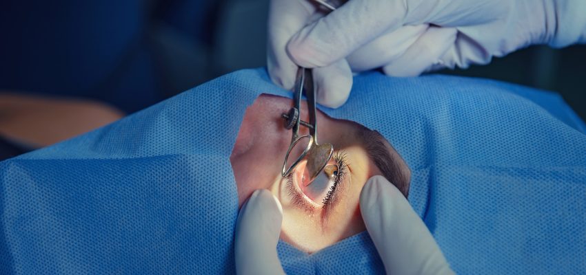 ניתוח קטרקט שאלות